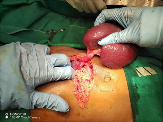 Intraoperative photograph showing an accessory spleen with a twisted long vascular pedicle, consistent with torsion.