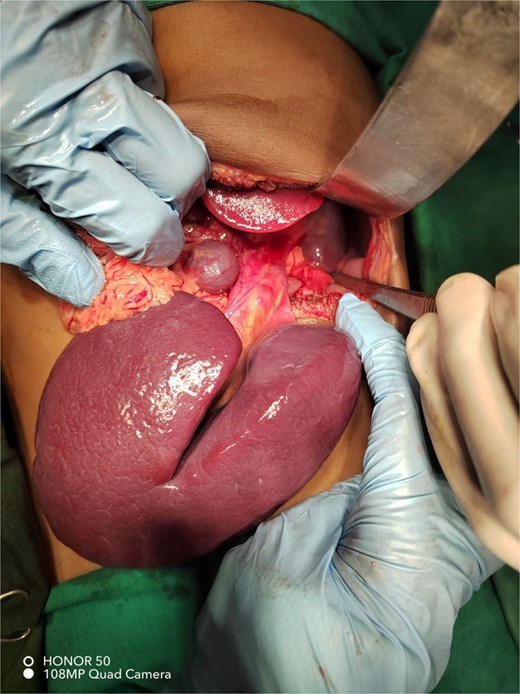 Intraoperative photograph showing two accessory spleens: A large fissured spleen with a long vascular pedicle and a smaller rounded splenule attached to the omentum. The normal spleen is seen in the left upper quadrant of the abdomen.
