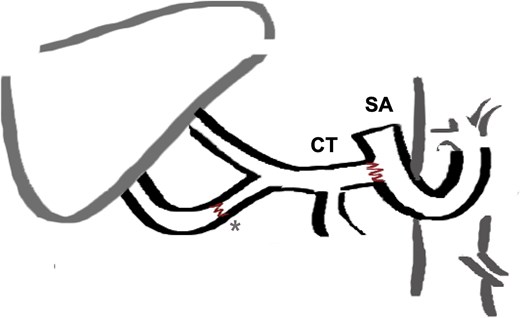 End to side arterial anastomosis between the donor celiac trunk (CT) and the recipient’s splenic artery (SA), which was transected and rotated counterclockwise to the porta hepatis. *Additional anastomosis between gastroduodenal artery and a right hepatic artery originating from the superior mesenteric artery (SMA, donor variant).