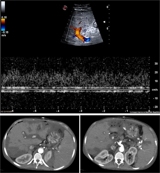 Imaging studies confirming hepatic artery thrombosis. (a) Doppler ultrasound showing absent hepatic artery flow. (b and c) CT angiography showing proximal hepatic artery occlusion with multiple hypodense areas in the liver parenchyma, consistent with ischemia and infarction.