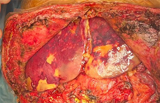 Intraoperative view of enlarged liver with heterogeneous texture and peripheral necrosis.