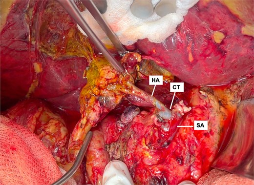 Intraoperative view showing thrombosed hepatic artery (HA) with anastomotic dilation and thrombus extension into the splenic artery (SA).