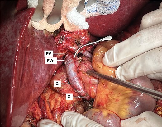 Portal inflow reconstruction using mesenteric to portal shunt with two iliac grafts (G). Anastomosis with portal vein remnant from last transplant (PVr) is shown.