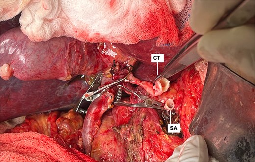 End-to-end arterial anastomosis between the donor celiac trunk (CT) with carrel patch and the recipient’s splenic artery (SA) origin.