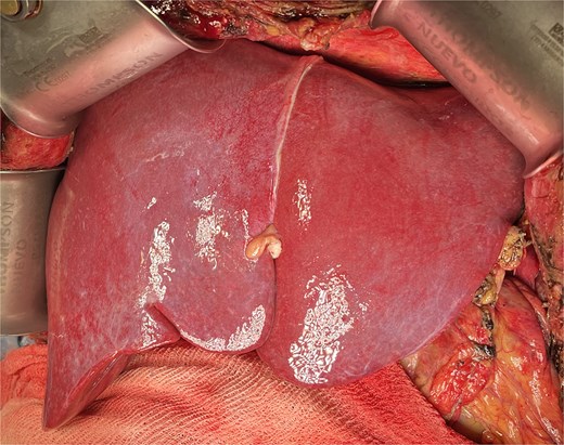 Final view showing homogeneous reperfusion of the liver following vascular reconstruction.