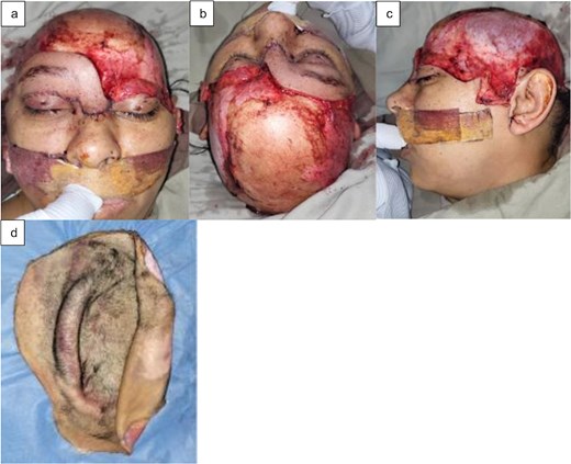(a) Frontal view, (b) superior view, (c) left lateral view of the scalp avulsion, and (d) avulsed scalp.