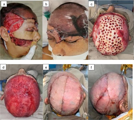 Sequential multi-reconstructive approach: (a) microsurgical reimplantation, (b) total necrosis of the flap, (c) trepanations, (d) coverage with dermal matrix, (e) superior view of the partial skin grafts, and (f) right lateral view.