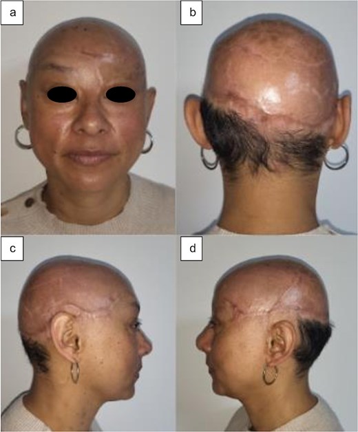 Postoperative outcomes at the fifth month: (a) anterior view, (b) posterior view, (c) right lateral view, and (d) left lateral view.