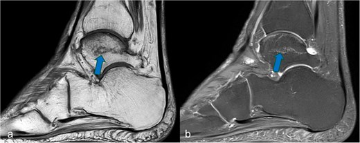 Sagittal MRI cross-sectional imaging showing (a) a T1-weighted and (b) a proton-weighted fat-suppressed image of the right tarsal bones. The ligamentous fracture in the trochlea tali was marked with arrows.