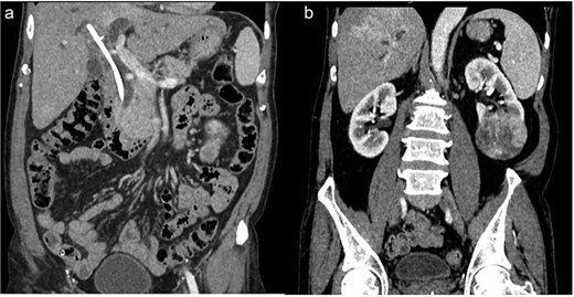 (a) Retained CBD stent. (b) Necrotic mass at lower pole of left kidney.