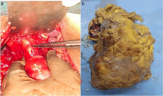(a) Dialated CBD. (b) Formalin fixed specimen of left kidney showing mass at lower pole.