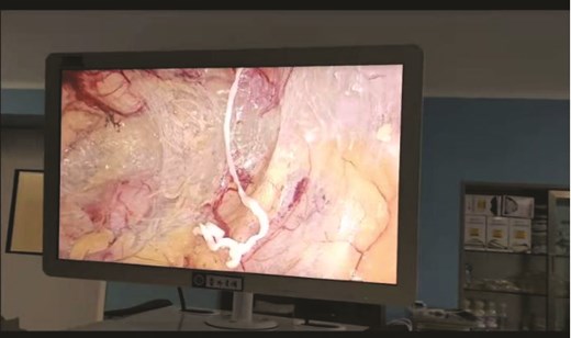Preperitoneal space white, elongated, motile parasitic worm.