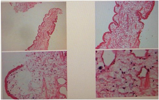 Postoperative pathology indicates that the submitted specimen is a parasitic organism.