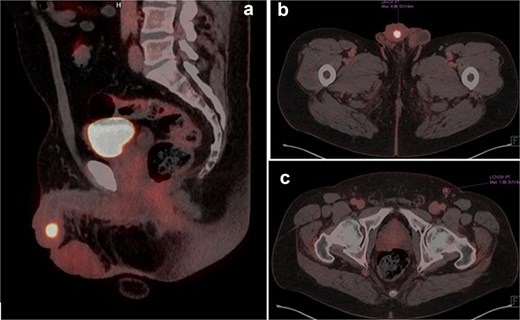 (a and b) PET-TC FDG-18 showing hypermetabolic lesion in glans. (c) Left inguinal lymph node positive in PET-TC.
