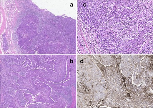 (a) Panoramic view of tumor located in the distal urethra with infiltration of connective tissue without extension to the muscular layer or cavernous body. (b) Tumor with syncytial pattern associated with marked mixed inflammatory infiltrate that partially masks the tumor cells. (c) Tumor cells with large and pleomorphic nuclei, prominent nucleoli, poorly defined borders, and frequent mitosis. (d) Immunohistochemical staining for PDL-1 shows intense positivity in the inflammatory component and in the tumor.