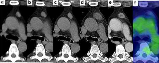 Computed tomography and positron emission tomography images demonstrate an enlarged anterior mediastinal nodule with low density in the central area and rapid shrinkage with little accumulation after the removal of dental crowns.