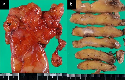Images of a macroscopic specimen of the resected anterior mediastinal nodule demonstrate that the targeted nodule was resected with a sufficient margin, and the nodule substantially regressed.