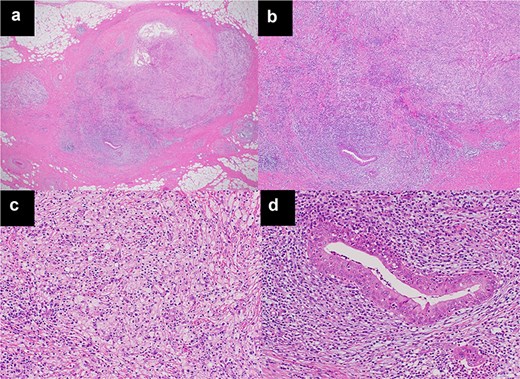 Microscopic findings with haematoxylin and eosin staining revealed xanthogranulomatous inflammation and abscesses, with no evidence of neoplasms, including thymoma. Only a few hollow epithelial cell structures, suggestive of normal thymic tissue in the nodule, were detected.