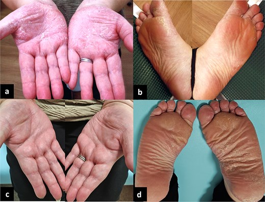 Photographs of palmoplantar lesions of her skin disease, pityriasis rubra pilaris, before and after the removal of dental crowns revealed that the palmar lesions were ameliorated after removal.