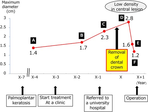 The timeline of the size of the anterior mediastinal nodules and events shows that the anterior mediastinal nodule shrank after the removal of the dental crowns.
