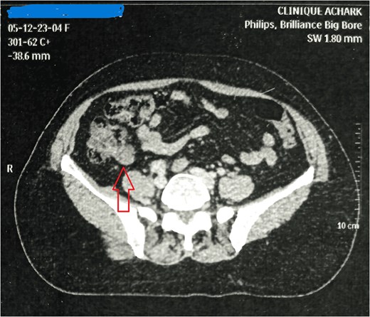 CT image showing an appendicular solido-cystic formation.