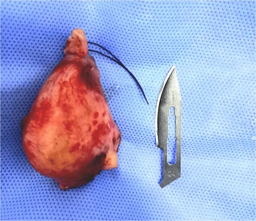 Appendectomy piece.