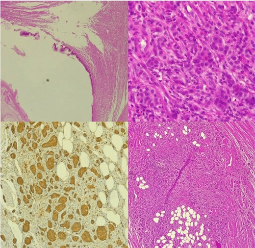Histological image of NET of the appendix associated with an appendiceal mucocele.