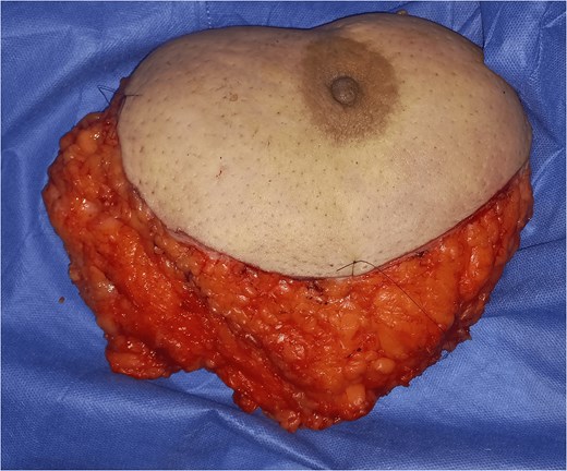 Photo of mastectomy.