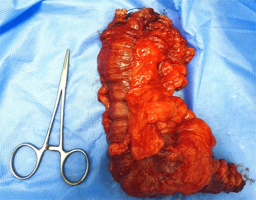 Piece of ileocecal resection.