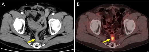 Imaging findings at the time of local recurrence diagnosis. (A) Contrast-enhanced CT. (B) Positron emission tomography-CT. Arrows indicate the recurrent lesion.