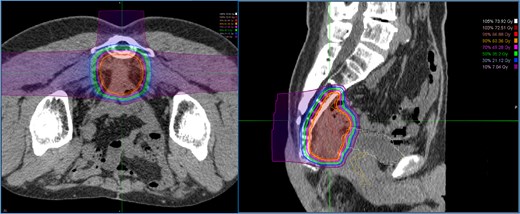 Dose distribution for carbon ion radiotherapy. The irradiation field includes the recurrent lesion, the anterior surface of the sacrum, and the adjacent small intestine.