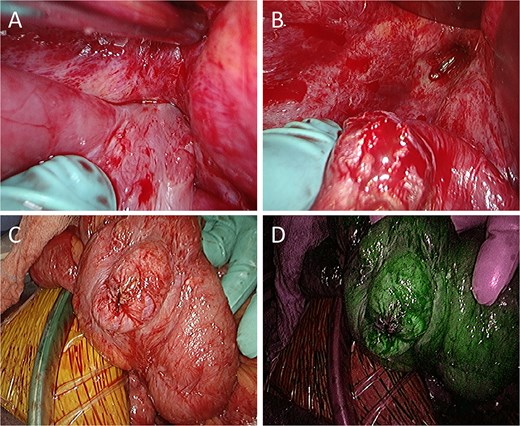 Intraoperative findings. (A) The small intestine is adherent to the locally recurrent lesion at the pelvic floor. (B) The adhesion is successfully separated without injury of the small intestine. (C) The serosal surface of the dissected small intestine shows no gross abnormalities. (D) ICG fluorescence imaging also reveals no evidence of decreased blood flow in the small intestine.