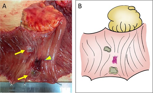 Macroscopic findings. (A) Ulcer formation on the mucosal surface caused by CIRT (arrows, ulcers; arrow head, adhesion site with the recurrent lesion). (B) Illustration of the macroscopic image.