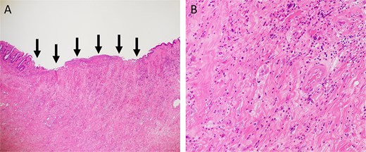 Hematoxylin and eosin staining. (A) Low-power view (magnification, ×40). Arrows indicate the ulcer base. (B) High-power view (magnification, ×200).