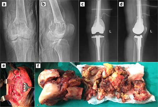 Radiographic and intraoperative findings in primary total knee arthroplasty. Preoperative anteroposterior (a) and lateral (b) radiograph of the knee showing a GCT with an associated fracture in the distal femur. Postoperative anteroposterior (c) and lateral (d) radiograph of the knee following primary total knee replacement. (e) Complete resection of the distal femur. (d) Gross specimens of the distal femur.