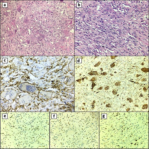 Histological features. (a) Multinucleated giant cell component. (b) Mononuclear cell component. (c) CD45 (+) membranous and cytoplasmic staining of multinucleated giant cells. (d) CD68 (+) cytoplasmic staining of multinucleated giant cells. (e) p53 (+) nuclear staining in mononuclear cells. (f) Nuclear staining in mononuclear cells with p63 (+). (g) Ki-67 (+) in 10% of mononuclear cells.