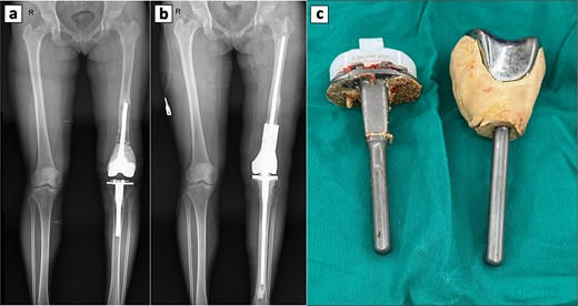 Perioperative radiographic imaging and retrieved prosthetic components following revision total knee arthroplasty. (a) Anteroposterior radiograph after primary total knee replacement, showing the femoral prosthesis loosening. (b) Anteroposterior radiograph after revision total knee replacement. (c) Retrieved prosthesis from the primary total knee arthroplasty, including femoral and tibial components.