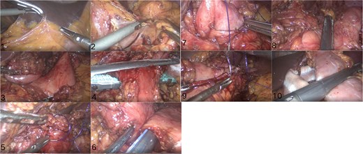 Surgical procedure.