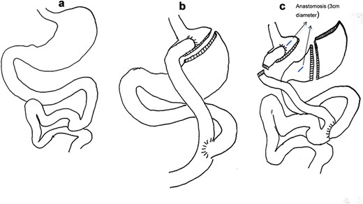 (a) Normal gastrointestinal tract structure. (b) RYGB schematic. (c) Small gastric bursa with open gastric anastomosis and sleeve gastrectomy schematic.