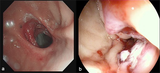 (a) Depicts the preoperative gastroscopy and (b) shows the postoperative gastroscopy.