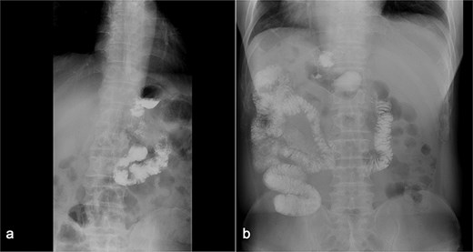 (a) Displays preoperative Gl contrast, while (b) depicts postoperative Gl contrast.