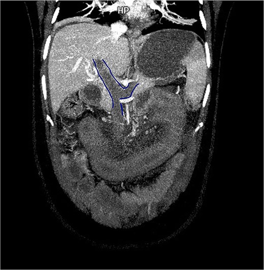 Contrast-enhanced CT in venous phase showing thrombosis of the portal, splenic, and superior mesenteric veins with proximal dilatation and thickening of the jejunal wall.