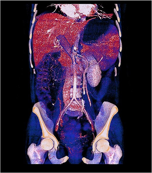 3D contrast-enhanced CT rendering reconstruction in venous phase showing thrombosis of the portal, splenic, and superior mesenteric veins with proximal dilatation and thickening of the jejunal wall.