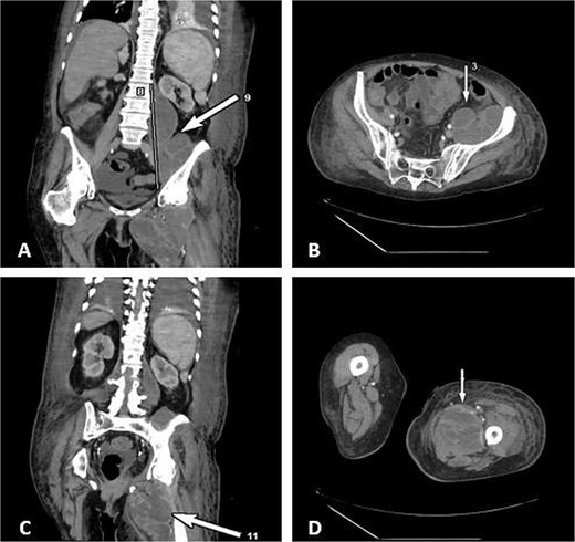 CT demonstrates multiloculated IPA with distal extension into the thigh adductor compartment. (A) Coronal CT showing a multiloculated IPA. (B) Axial CT demonstrating the psoas collection. (C) Coronal CT illustrating distal extension along the psoas sheath into the adductor compartment. (D) Axial CT of the thigh confirming distal involvement.