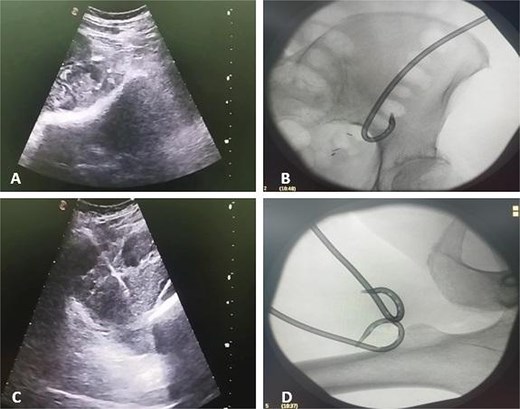 Ultrasound and fluoroscopy show multi-access percutaneous drainage with one retroperitoneal and two femoral catheters. (A) Ultrasound-guided retroperitoneal puncture into the psoas collection. (B) Fluoroscopic image demonstrating catheter placement in the psoas component. (C) Ultrasound-guided puncture of the thigh extension. (D) Fluoroscopic confirmation of one retroperitoneal and two femoral drains in situ.