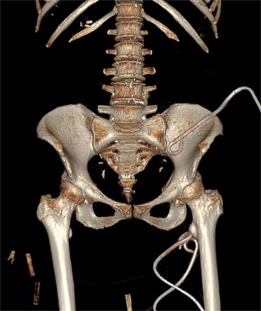 3D CT reconstruction depicting the final positions of the drainage catheters.