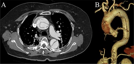 Preoperative contrast-enhanced CT images. (A) Stanford type A acute aortic dissection with the primary entry tear extending from the ascending aorta to the aortic arch, showing a patent false lumen. (B) Three-dimensional reconstructed image.