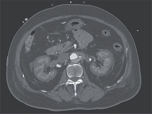 Contrast-enhanced CT image acquired on postoperative Day 2, showing the reverse rim sign.