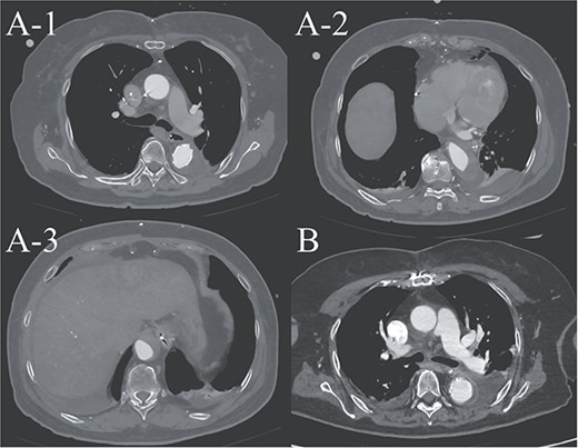 (A-1–3) contrast-enhanced CT image acquired on postoperative Day 2, showing advanced false lumen thrombosis. (B) Contrast-enhanced CT image acquired on postoperative Day 21, demonstrating further remodeling of the false lumen. This image is at approximately the same level as A-1, and the false lumen's thickness is clearly reduced.