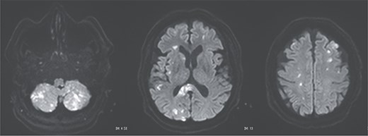 Postoperative magnetic resonance imaging showing diffuse cerebral infarctions.